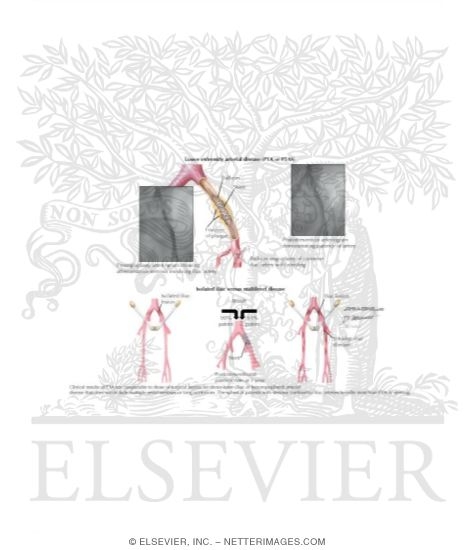 Watermarked preview of labeled image: Interventional Approaches to Peripheral Arterial Disease