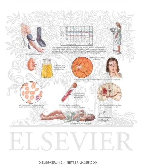 Watermarked preview of labeled image: Preeclampsia / Eclampsia