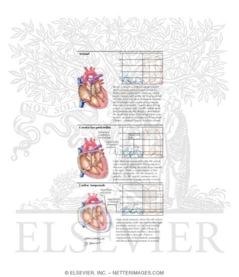 Watermarked preview of labeled image: Comparison of Normal and Pathologic Intracardiac Pressures