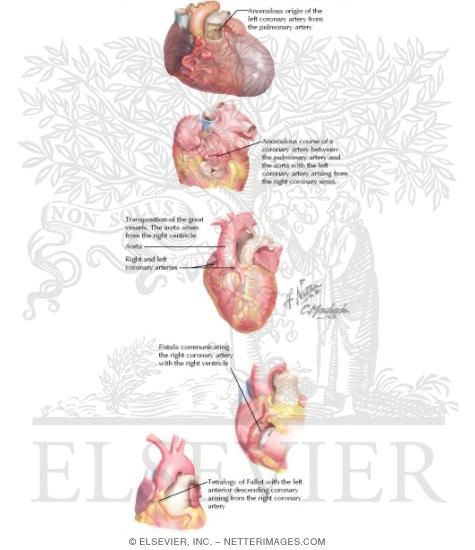Congenital Coronary Ar...