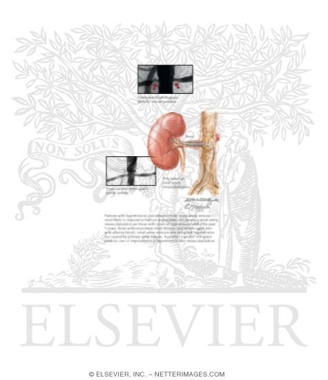 Percutaneous Revascularization of Stenotic Renal Arteries