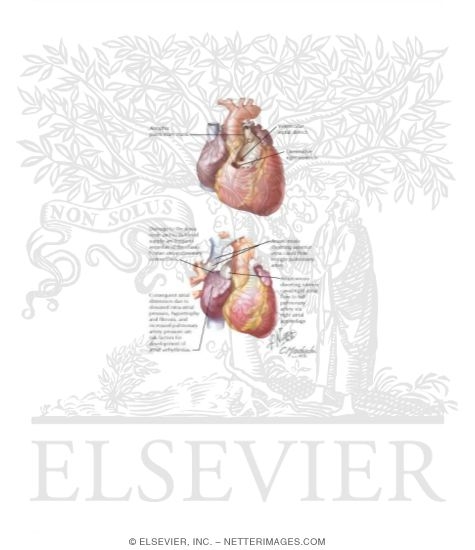 Watermarked preview of labeled image: Tricuspid Atresia