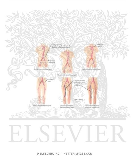 Watermarked preview of labeled image: Surgical Management of Peripheral Arterial Disease of Lower Extremity