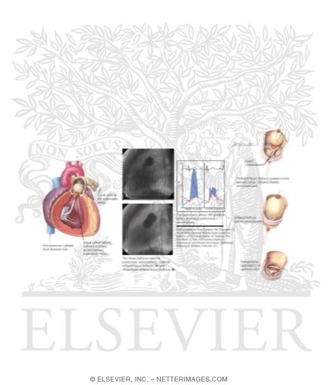 Pulmonary Balloon Valvuloplasty
