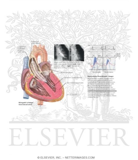 Aortic Balloon Valvuloplasty