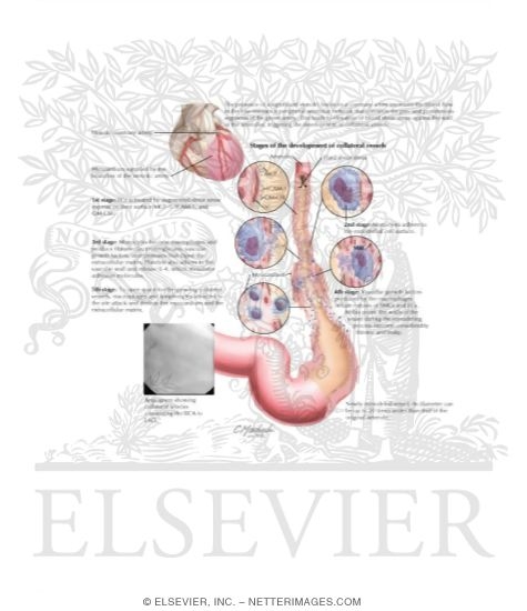 Watermarked preview of labeled image: Mechanisms of Arteriogenesis and Development of Collateral Vessels