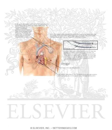 Watermarked preview of labeled image: Implantable Cardiac Defibrillator (Dual-Chamber Leads)