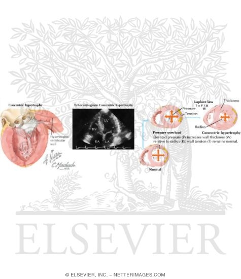 Watermarked preview of labeled image: Left Ventricular Hypertrophy