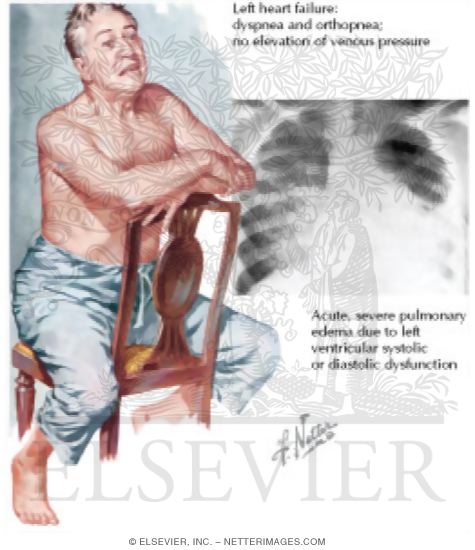 Left Heart Failure and Pulmonary Congestion