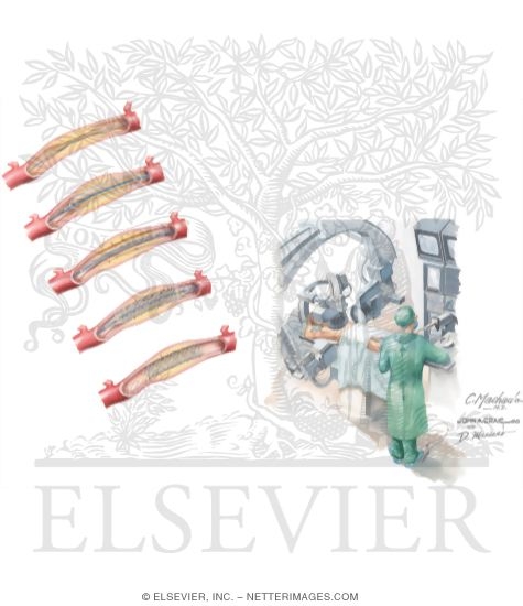 Acute Percutaneous Coronary Intervention (PCI) In the Management of Myocardial Infarction (MI) With ST-elevation (STEMI)