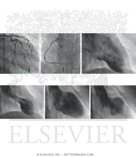 Watermarked preview of unlabeled image: Takotsubo Cardiomyopathy