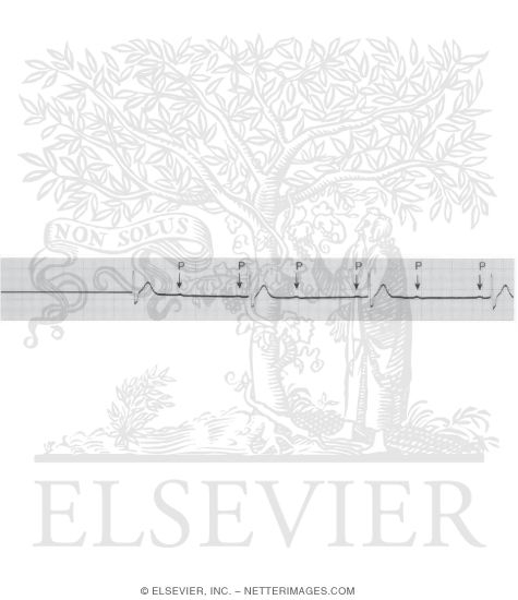Watermarked preview of unlabeled image: Second-degree Atrioventricular Block