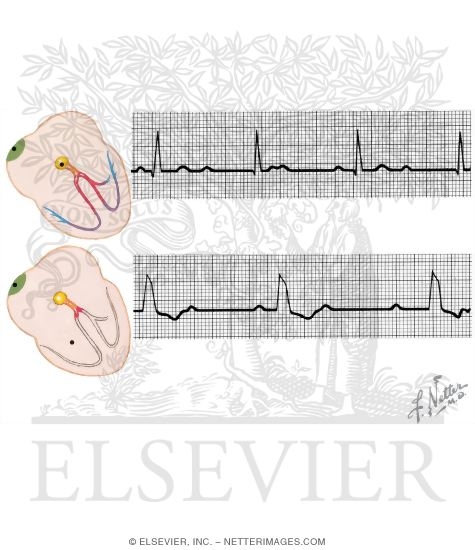 Complete Atrioventricular (AV) Block