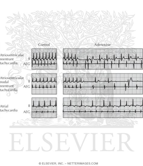 Watermarked preview of unlabeled image: Effect of Adenosine On Atrioventricular Reentrant Tachycardia, Atrioventricular Nodal Reentrant Tachycardia, and Atrial Tachycardia