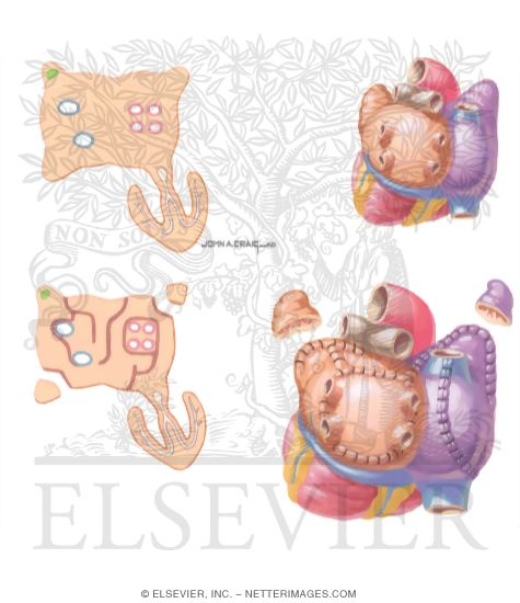 Watermarked preview of unlabeled image: Surgical Management of Atrial Fibrillation