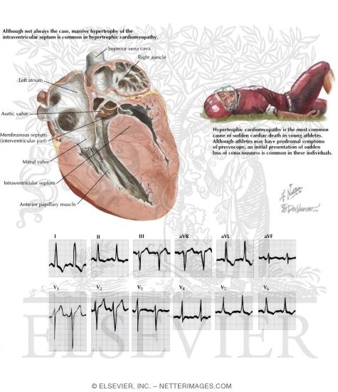 Watermarked preview of labeled image: Sudden Death In Hypertrophic Cardiomyopathy