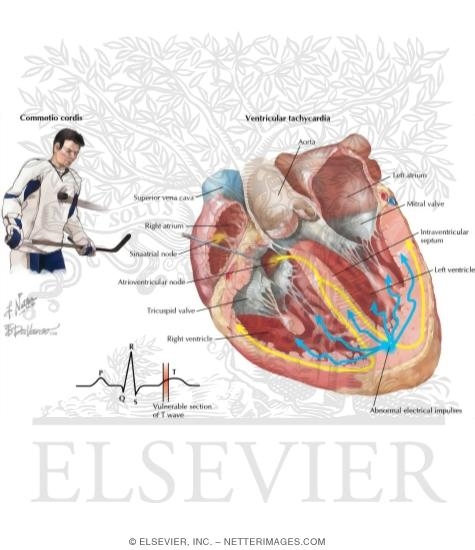 Mechanism of Sudden Cardiac Death In Commotion Cordis