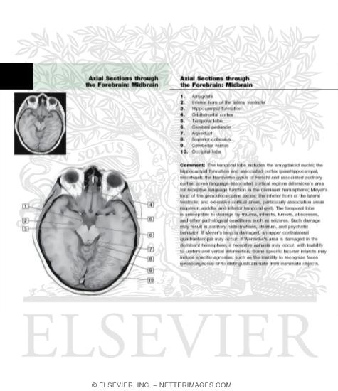 Axial (Horizontal) Sections Through the Forebrain: Level 3 - Midbrain