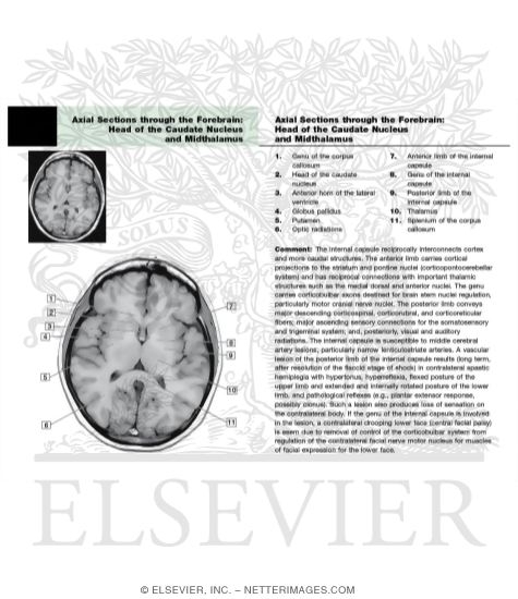 Watermarked preview of labeled image: Basal Ganglia and Internal Capsule