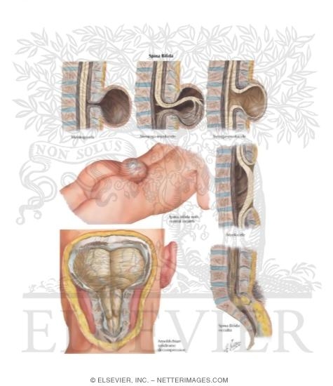 Watermarked preview of labeled image: Spina Bifida