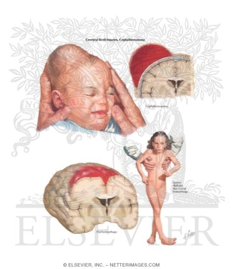Cerebral Birth Injuries, Cephalhematoma