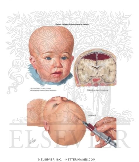 Watermarked preview of labeled image: Chronic Subdural Hematoma In Infants