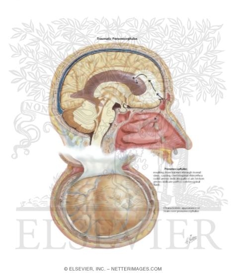 Watermarked preview of labeled image: Traumatic Pneumocephalus