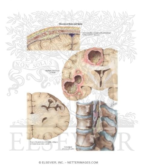 Watermarked preview of labeled image: Abscess of Brain and Spine