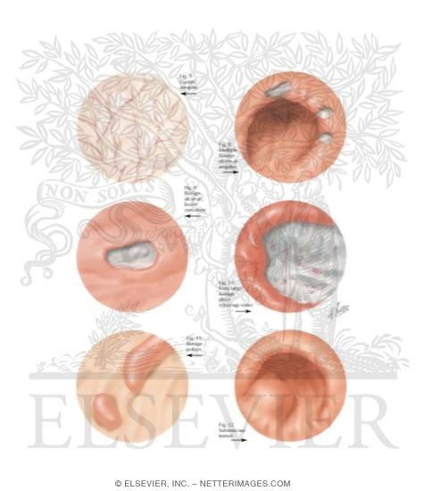 Watermarked preview of labeled image: Gastroscopic Diagnosis Of Malignant Disease