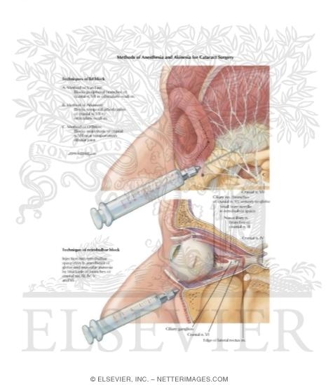 Watermarked preview of labeled image: Methods of Anethesia and Akinesia for Cataract Surgery