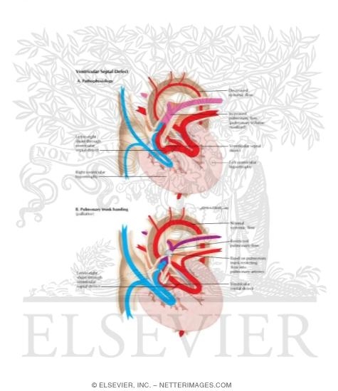 Watermarked preview of labeled image: Ventricular Septal Defect