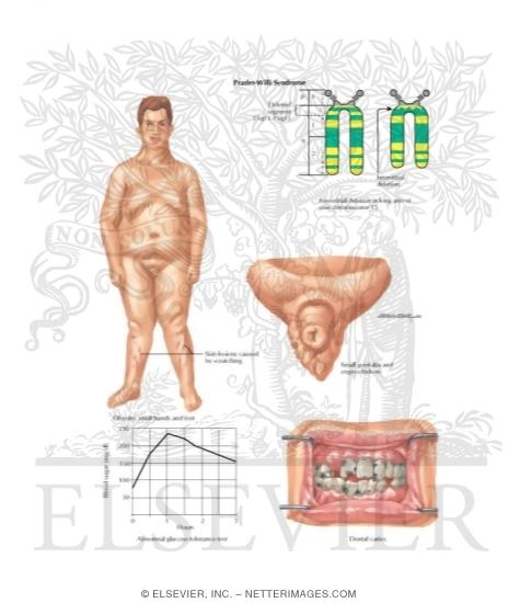 Cytogenetic Diseases Prader-willi Syndrome