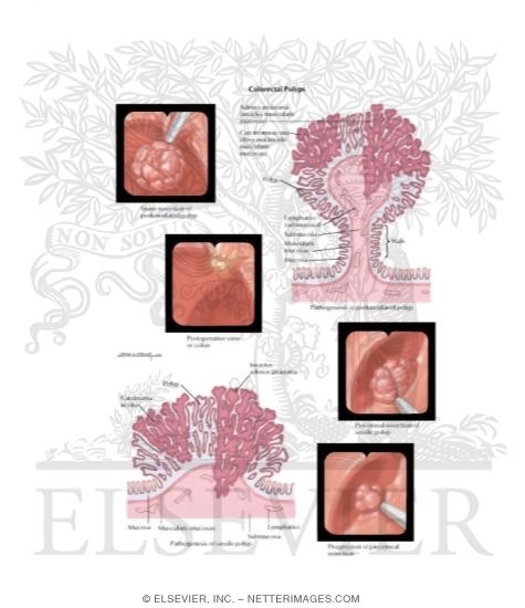 Watermarked preview of labeled image: Colorectal Cancer Colorectal Polyps