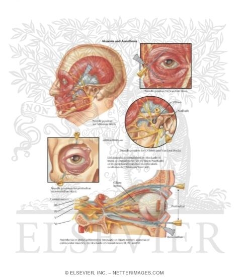 Watermarked preview of labeled image: Cataracts Akinesia and Anesthesia