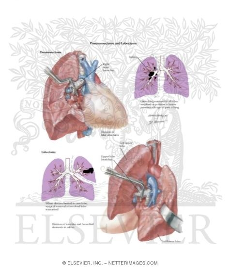 Pneumonectomy and Lobectomy