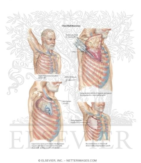 Watermarked preview of labeled image: Chest Wall Resection and Reconstruction In Superior Sulcus Tumor
