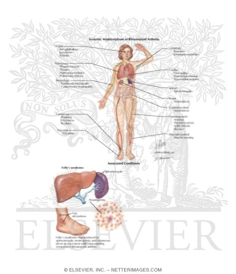 Watermarked preview of labeled image: Systemic Manifestations of Rheumatoid Arthritis