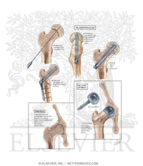 Watermarked preview of labeled image: Disorders of Hip