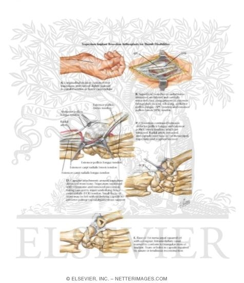 Watermarked preview of labeled image: Trapezium Implant Resection Arthroplasty for Thumb Disabilities