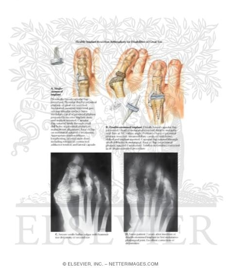 Watermarked preview of labeled image: Flexible Implant Resection Arthroplasty for Disabilities of Great Toe