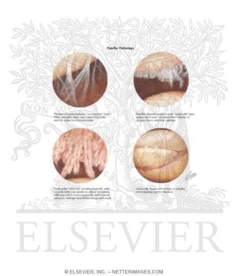 Watermarked preview of labeled image: Patellar Pathology: Arthroscopic Views