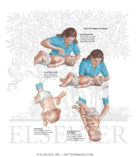 Watermarked preview of labeled image: Basic Life Support in Infants
