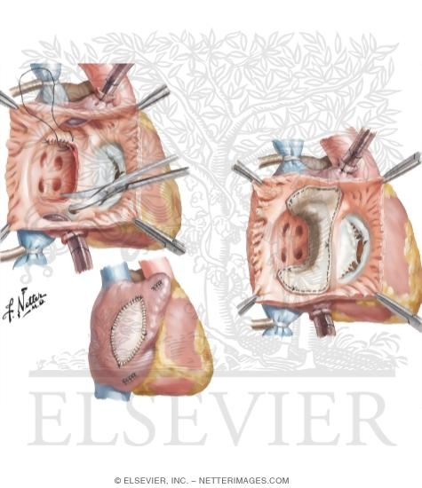 Watermarked preview of unlabeled image: Arterial Repair of Transposition of the Great Arteries