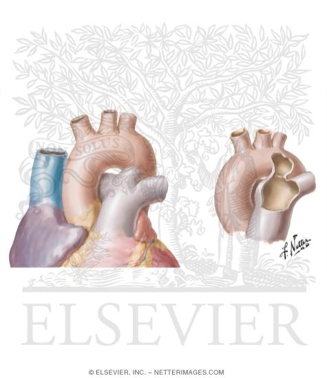 Patent Ductus Arteriosus
