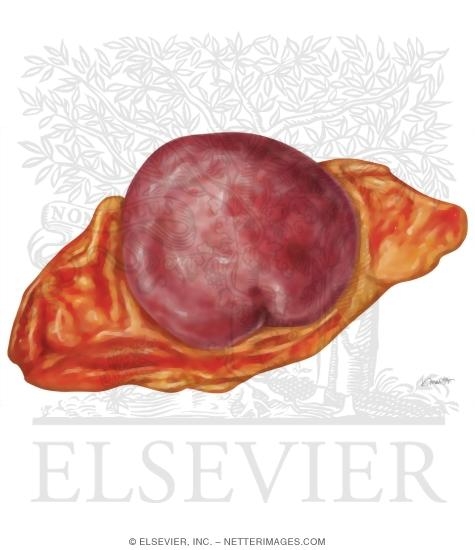 Watermarked preview of unlabeled image: Pheochromocytoma and Paraganglioma