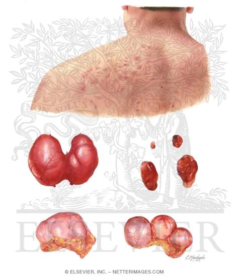 Watermarked preview of unlabeled image: Multiple Endocrine Neoplasia Type 2