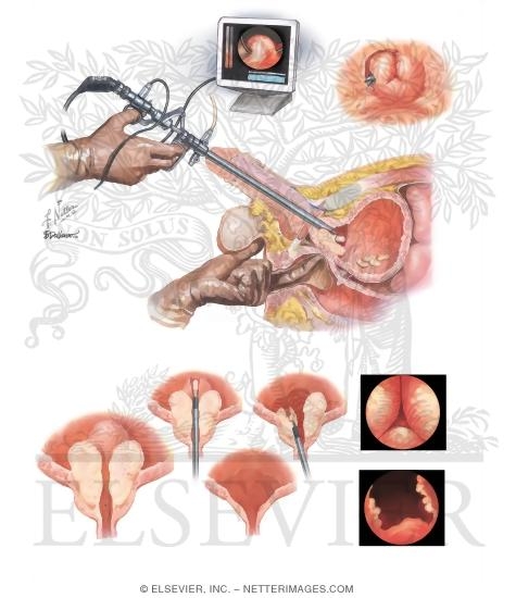 Watermarked preview of unlabeled image: Benign Prostate Surgery IV: Transurethral