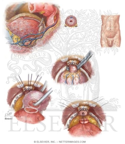 Watermarked preview of unlabeled image: Malignant Prostate Surgery I: Retropubic