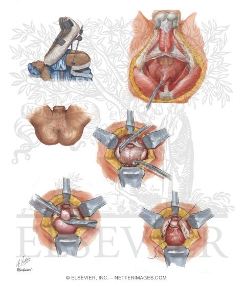 Watermarked preview of unlabeled image: Malignant Prostate Surgery II: Perineal