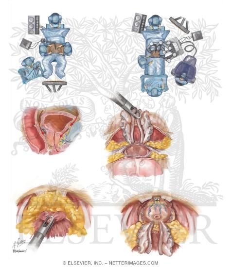 Malignant Prostate Surgery I: Laparoscopic and Robotic